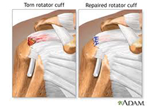 Shoulder Arthtitis | Rotator Cuff Tear Repair | Reisterstown MD | Owings Mills MD