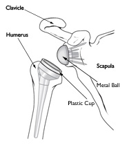 Shoulder Arthtitis | Rotator Cuff Tear Repair | Reisterstown MD | Owings Mills MD