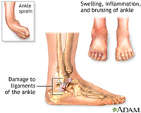 Hip Fracture Treatment | Ankle Sprain Treatment | Reisterstown MD | Owings Mills MD