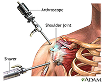 Shoulder Arthtitis | Rotator Cuff Tear Repair | Reisterstown MD | Owings Mills MD