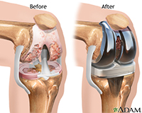 Knee Replacement | ACL Tear Treatment | Reisterstown MD | Owings Mills MD