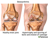 Knee Replacement | ACL Tear Treatment | Reisterstown MD | Owings Mills MD