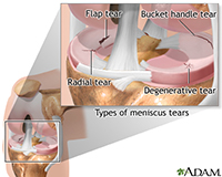 Knee Replacement | ACL Tear Treatment | Reisterstown MD | Owings Mills MD